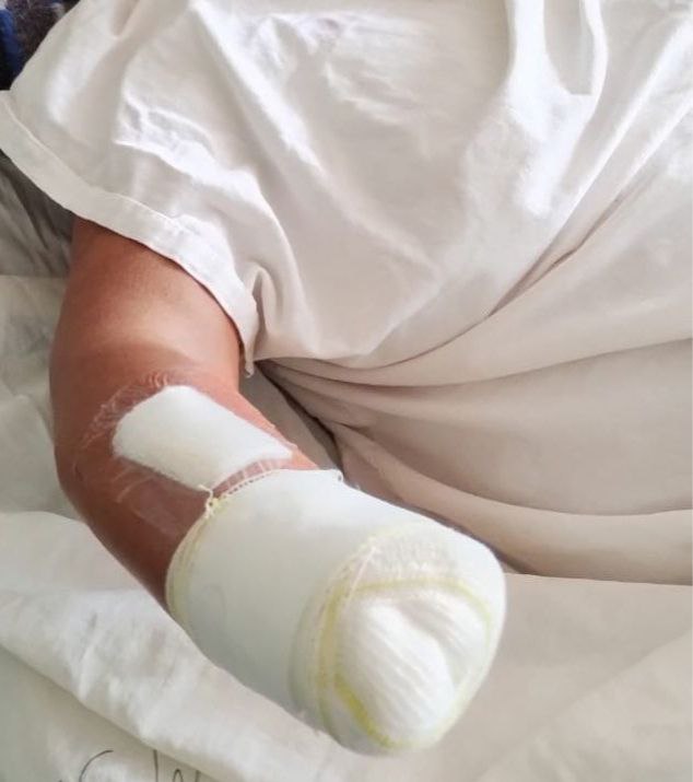 Mulher agredida com foice e facão tem a mão amputada no ES